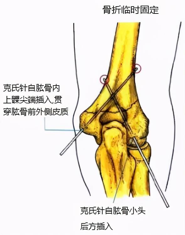 肱骨遠端粉碎性骨折怎麼辦