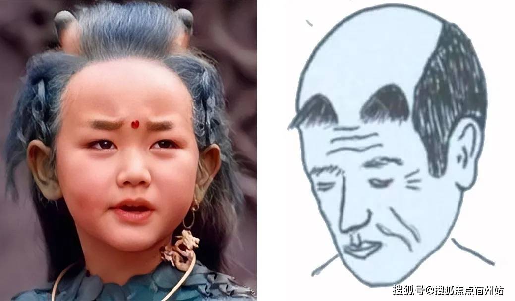 随着年龄的增长,头发还是会整体往后移,到时候只剩下填过的两撮毛发