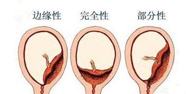 一般來說,胎盤的位置可能會出現在子宮前壁,後壁或側壁,但有部分準