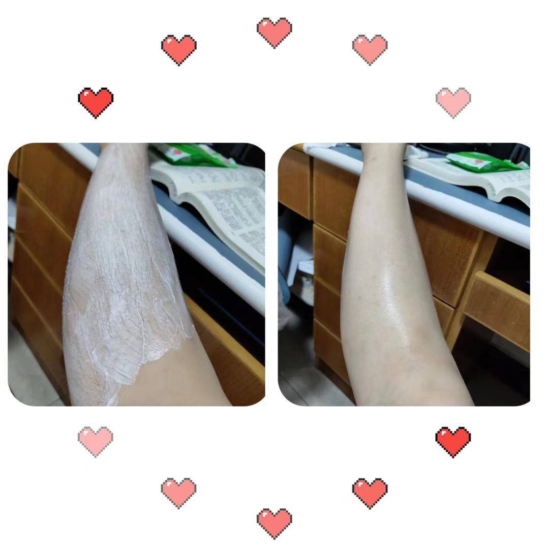 脱毛膏会使鸡皮肤更严重吗(脱毛膏会使鸡皮肤更严重吗女生)