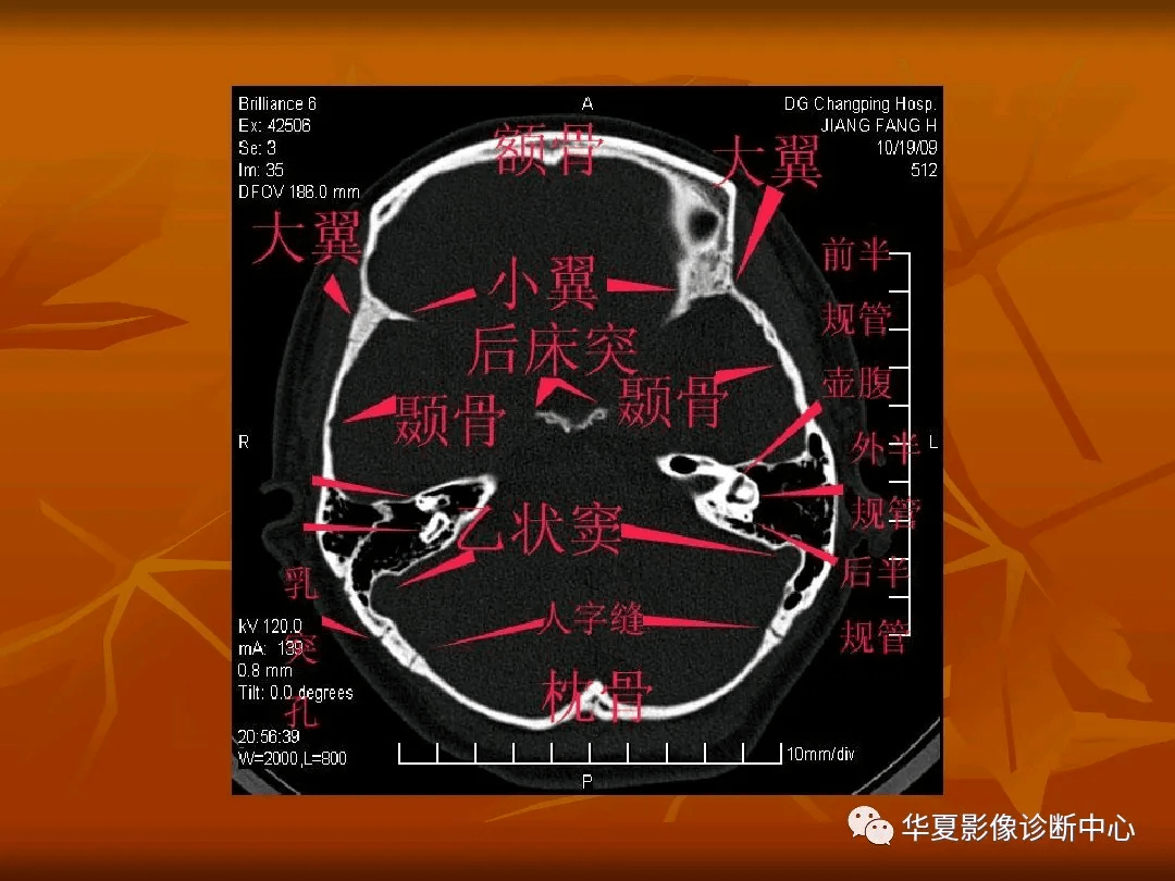 顱底ct高清圖解 常見骨折部位圖示