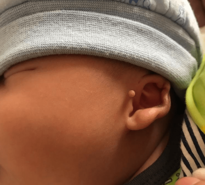 宝宝耳朵上有拴马桩代表有福气?