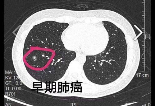 年年体检正常 怎么突然就成了肺癌晚期 症状