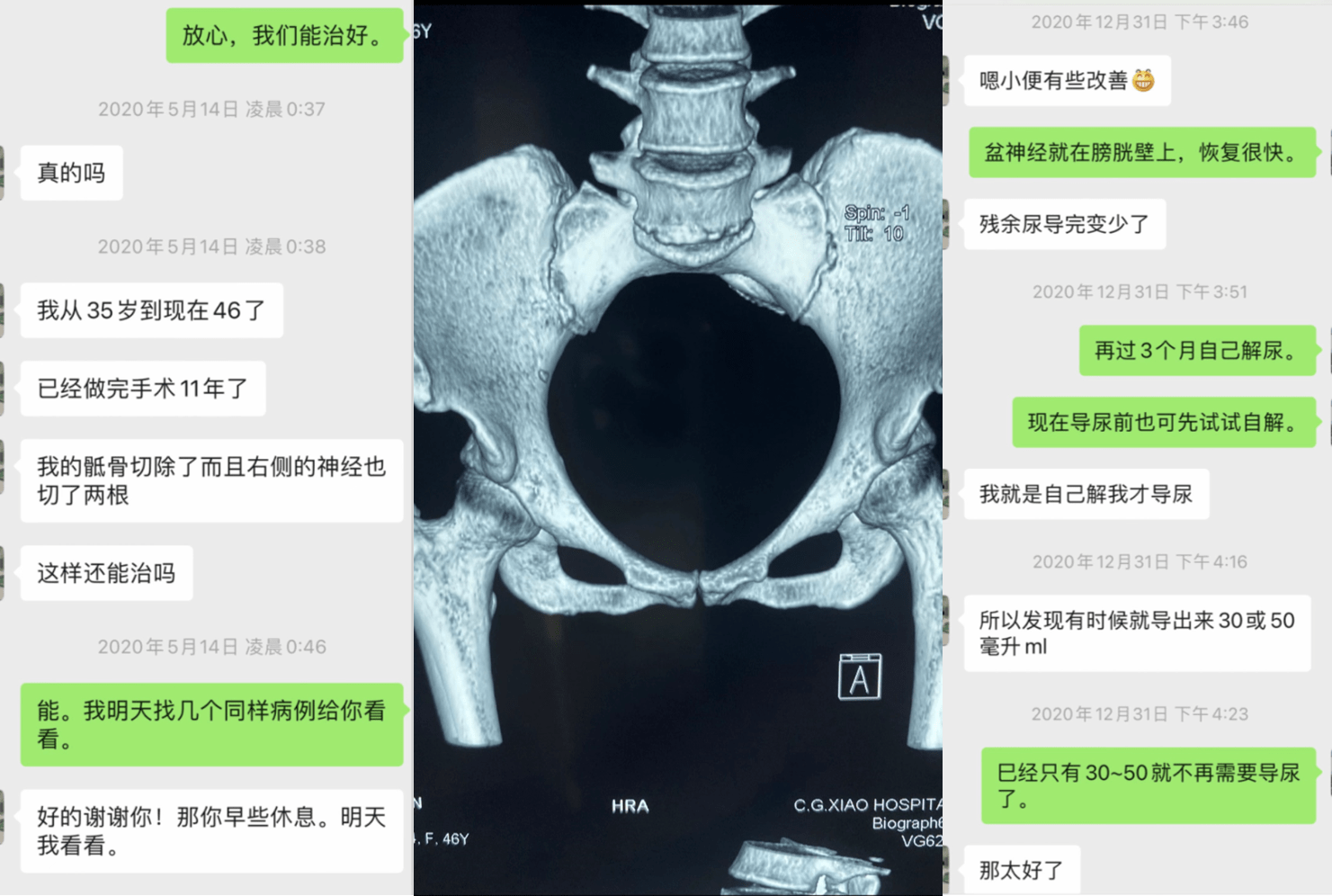 骶尾骨腫瘤致神經源性膀胱病人恢復排尿,深圳肖傳國醫院再添治癒案例