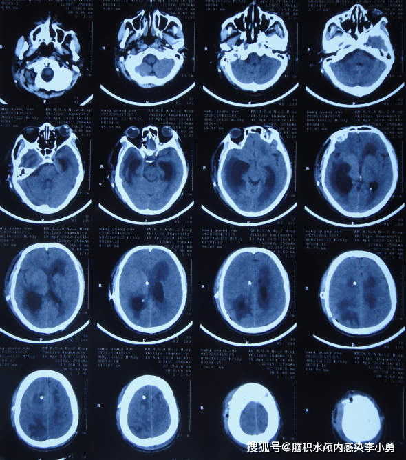 图-18:2020年4月10日头颅ct图-17:2020年4月2日头颅ct第二家医院继续