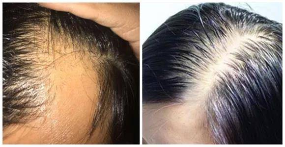 脂溢性脱发,又称雄性激素源性脱发,多发生于皮脂腺分泌旺盛的青壮年