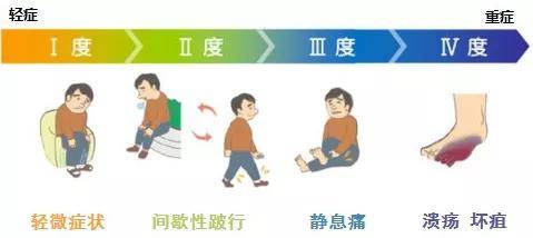 老人腿麻怕冷謹防下肢動脈硬化閉塞症深圳二院杜端明