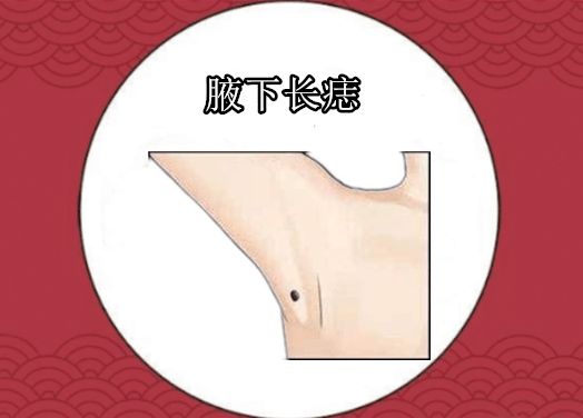 腋下長痣