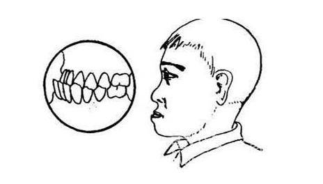 咬勺子和筷子能矫正地包天 民间偏方不可轻信 进行