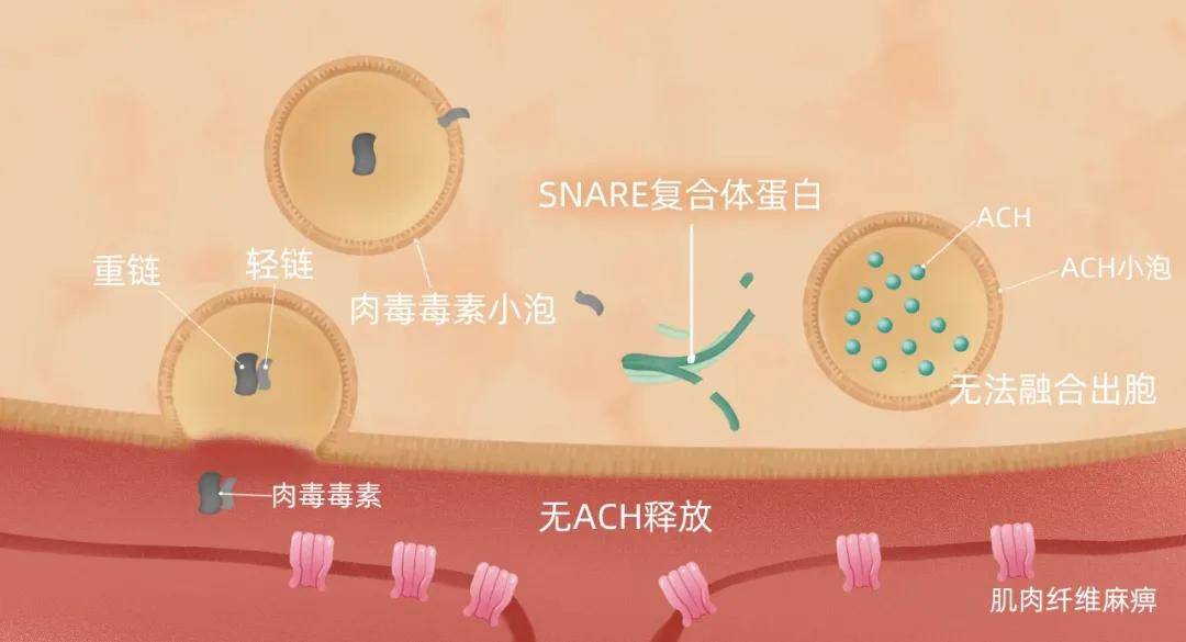 肉毒毒素入侵后,与神经元膜上的受体结合,通过胞吞作用形成小泡进入