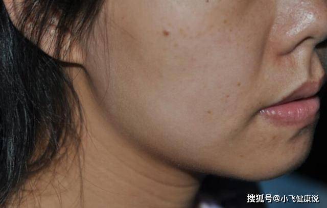 吃橘子后皮肤变黄,是橘子里有激素吗?胡萝卜素的影响,不用担心