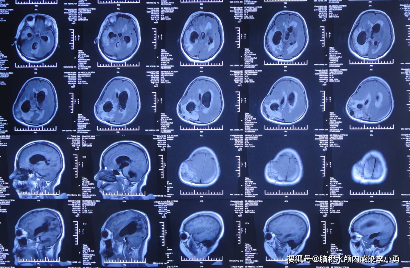 肢體活動變差且無法下地行走,查頭顱mri示腦積水腦膨出變更嚴重(圖-9)