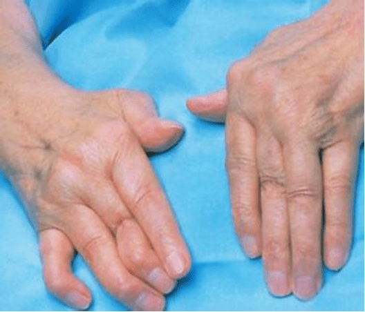 以远端指间关节受累最为常见,表现为关节两侧骨性膨大.