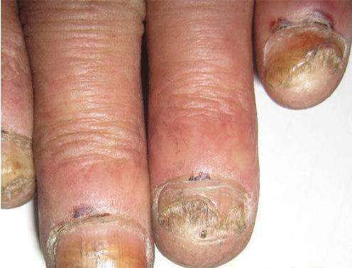 皮肤科普:灰指甲症状图片