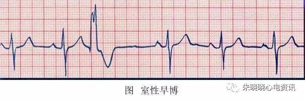 心律失常49问