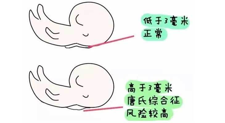 12周时还有个重点项目nt检查