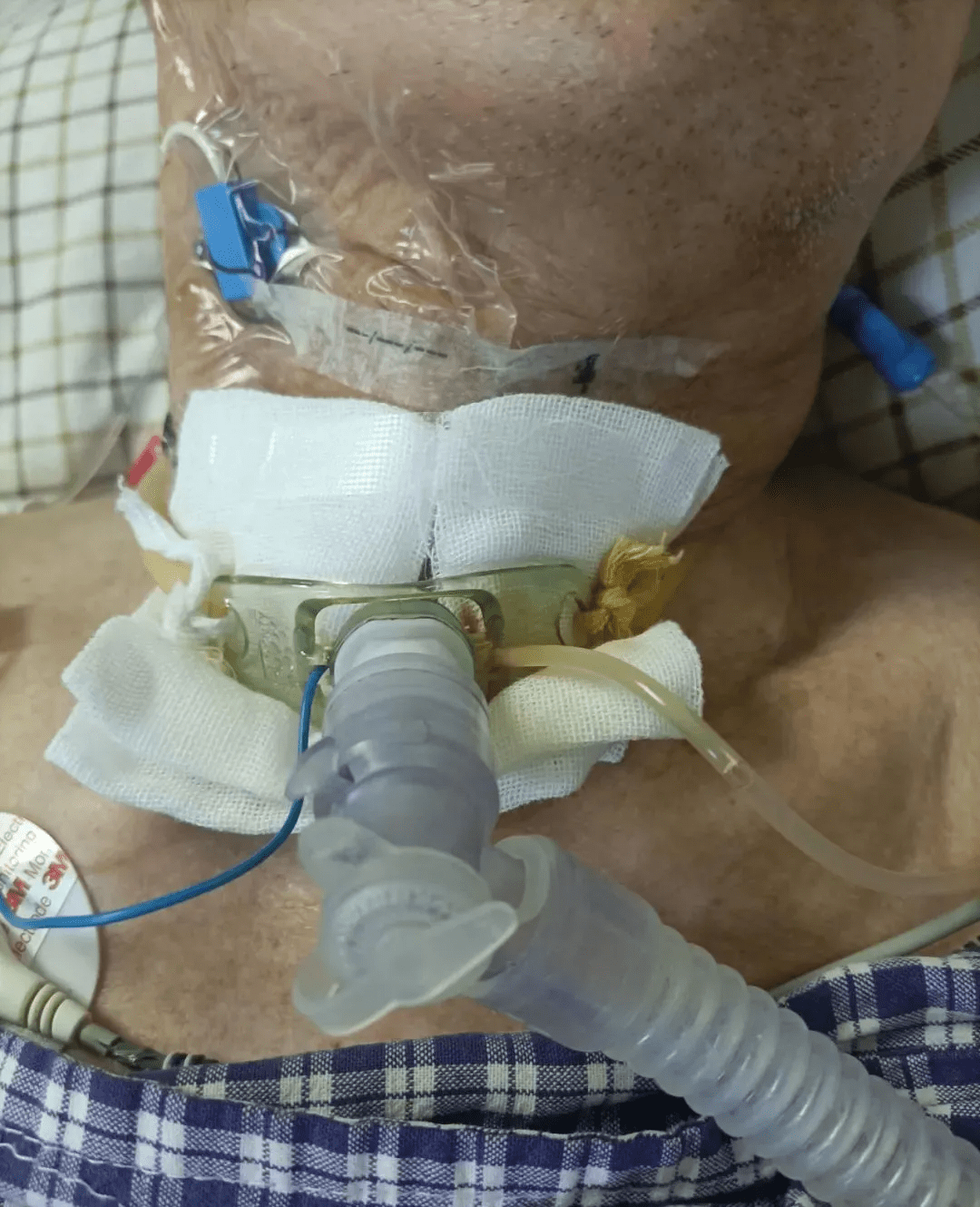 医院icu成功为患者实施床旁超声定位纤支镜引导下经皮微创气管切开术