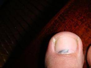 03脚底发黄,干燥,易裂开不只是手,脚的颜色可以看出肝脏是否健康.