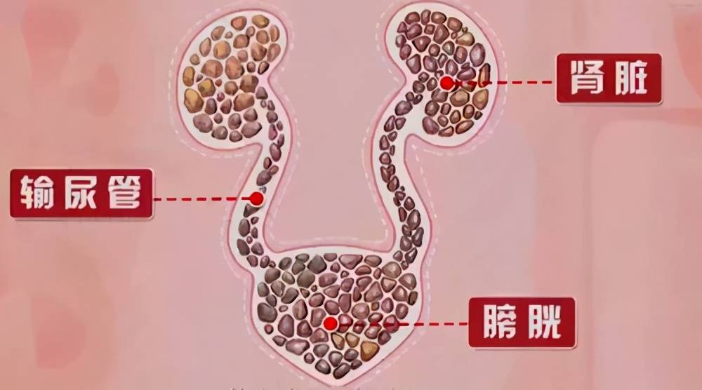 腎結石誤區盤點您中了幾個