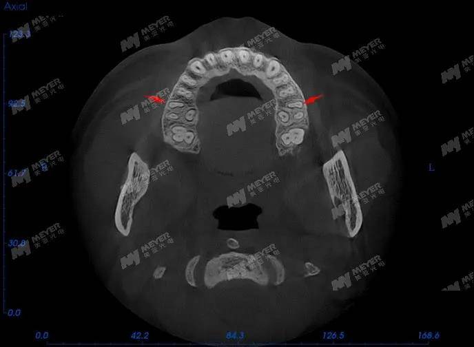 美亞口腔cbct全新局部ct功能上線