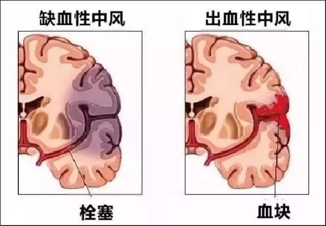 手术后的人口齿不清是麻药的药效吗(3)