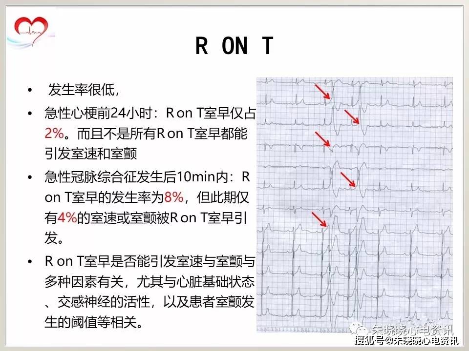 ront型室性早搏图片