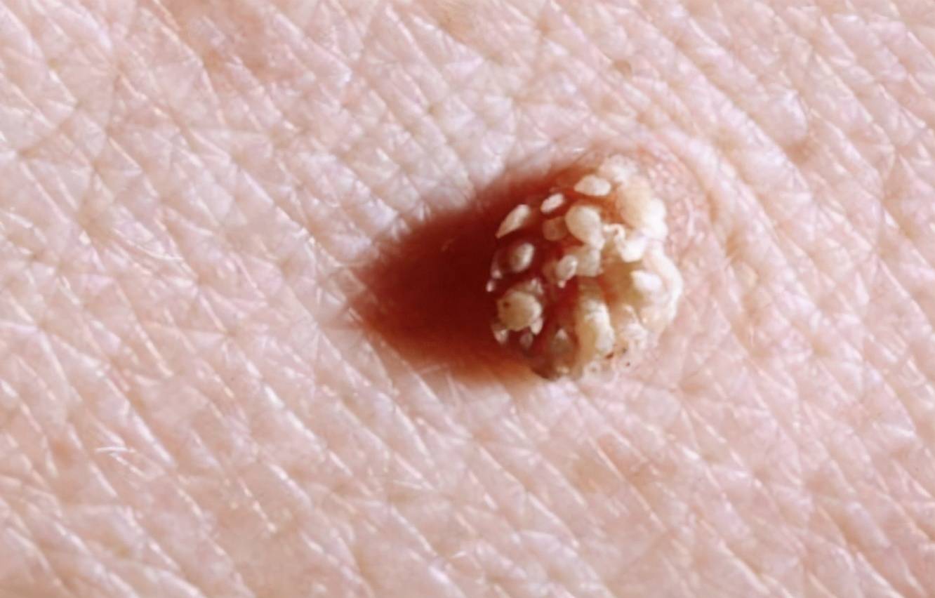 大三情侣感染hpv,女友当场分手,医生:这5种男友,遇到绕道走