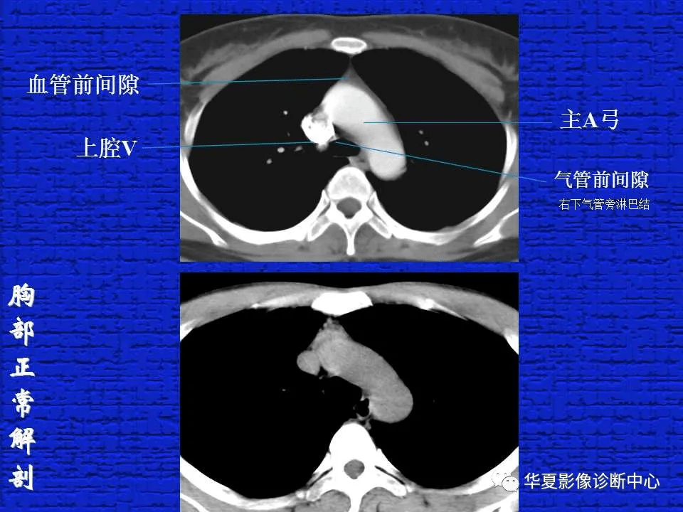 ct入門結合解剖談正常胸部ct讀片