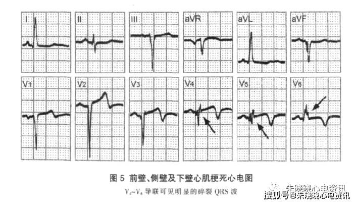 存 活的心肌除极将发生延迟和缓慢并在病理性q波或qs波中形成振幅较低