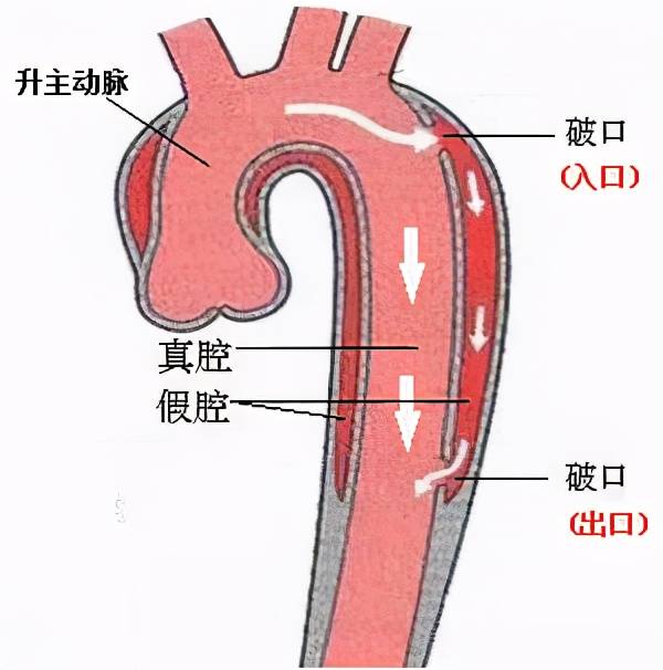 旋风杀手,主动脉夹层是什么病?