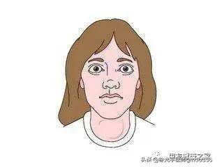 甲亢疾病别忽视，会遗传给下一代