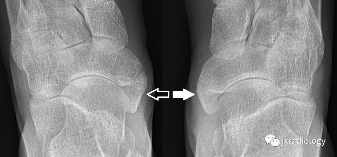副舟骨与舟骨结节融合在一起,导致舟骨结节明显突出,约占4～21%.
