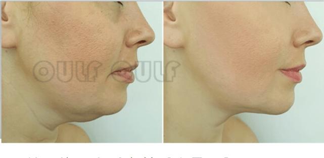 能量|大揭秘、热玛吉和超声刀的区别、千万不要选错呀~