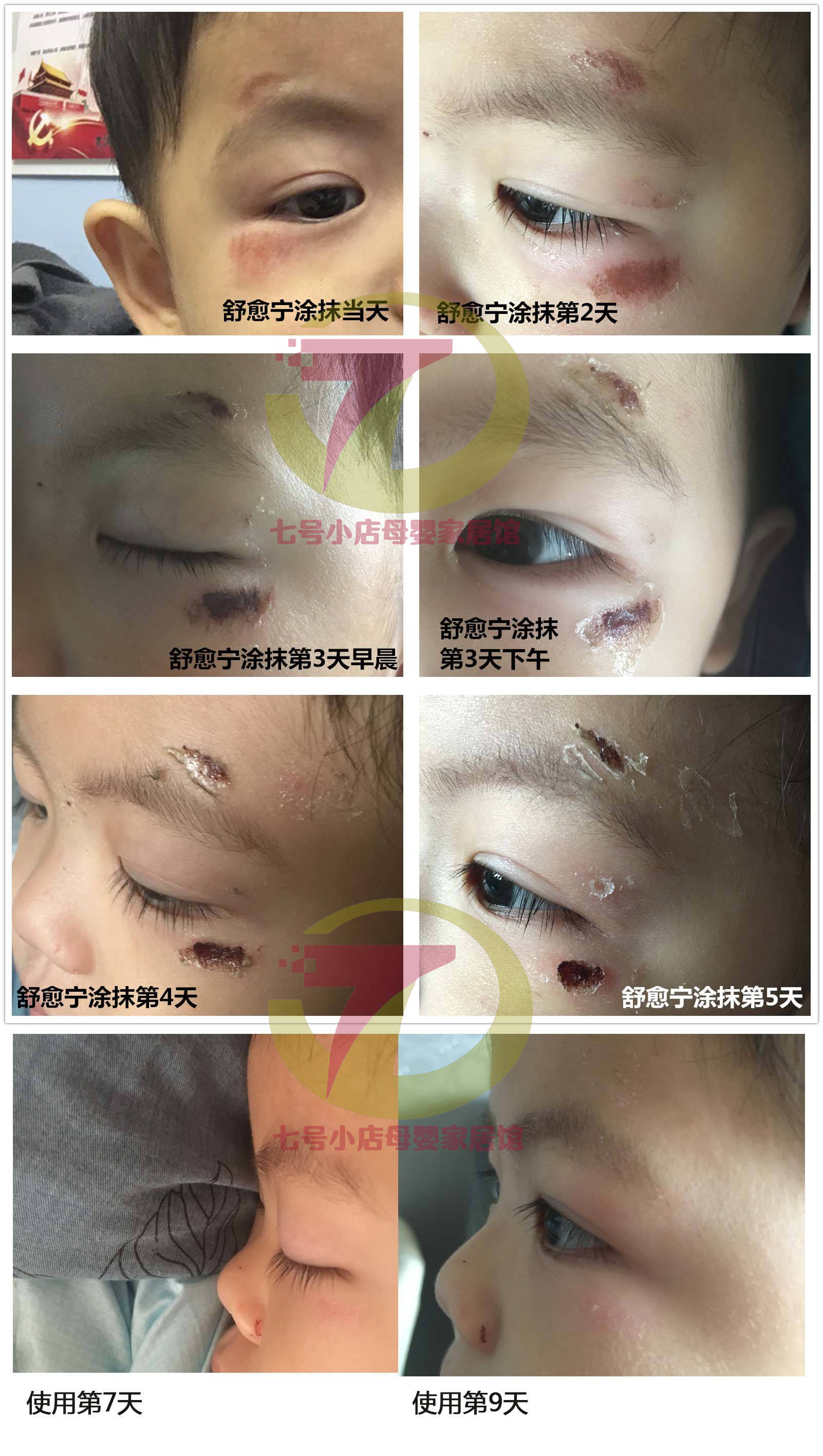 蓝冠舒愈宁 完美解决乳头皲裂,哺乳疼痛问题,白泡反复不疼了