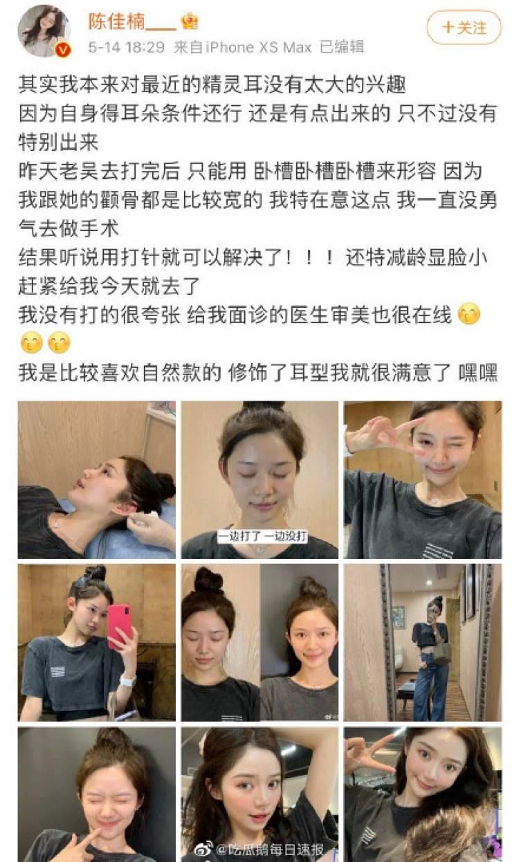 精灵耳 走红整形圈 网友 我二十几年的招风耳终于等到流行