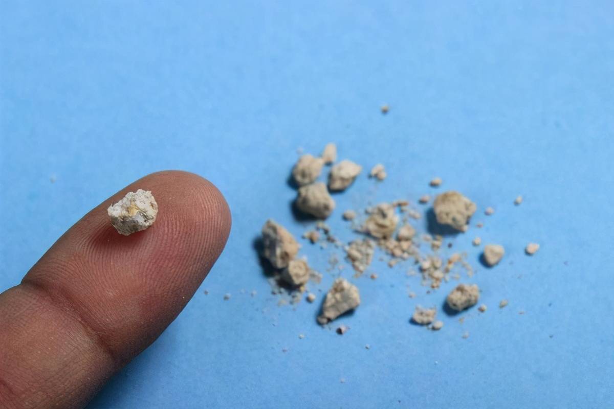 原创胆结石患者除了有绞痛感还可能出现全身发热及黄疸症状