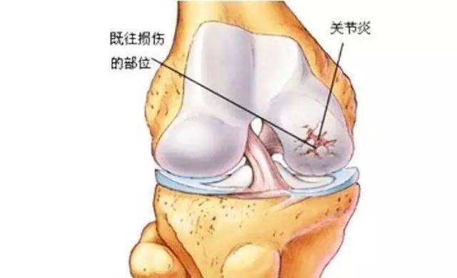 膝骨关节炎的临床表现为膝关节疼痛,肿大变形,僵硬,压痛,骨摩擦音
