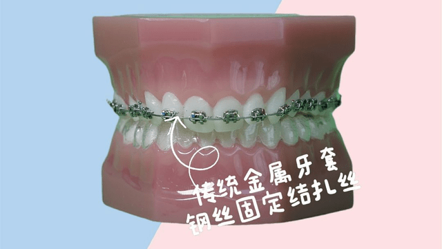 1.传统金属牙套