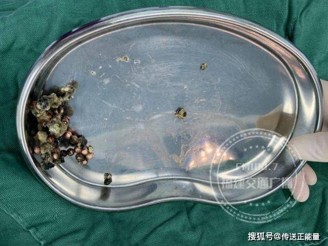 為追求刺激,福州一男子把一串磁珠塞入尿道,卻不慎掉進膀胱