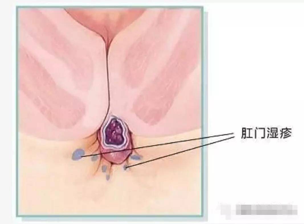 药膏|肛周湿疹用什么药