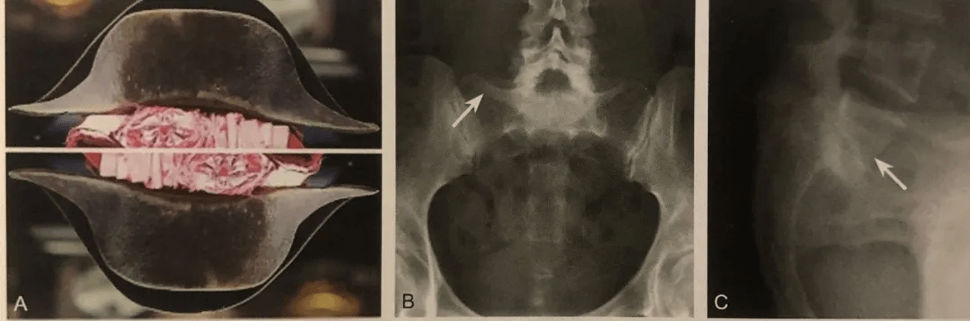 20个常见骨关节影像征象,你认识几个?_箭头