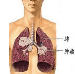 女性肺癌早期症状图片图片