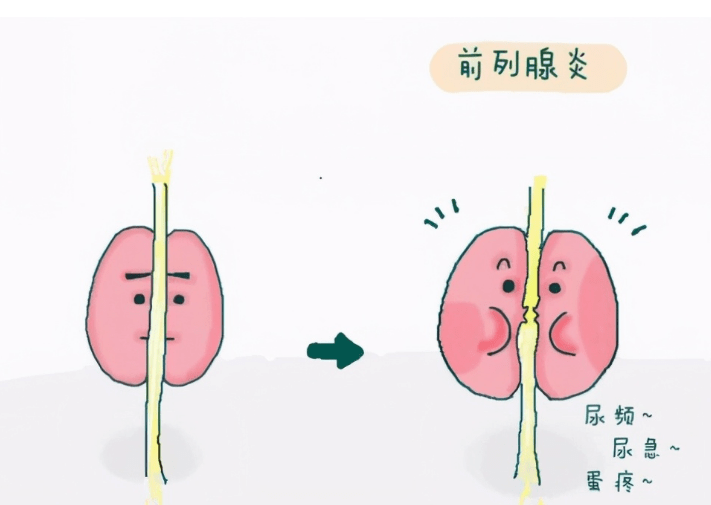 男人身上1处疼痛,2处异常,可能是前列腺炎找上门?应趁早就医