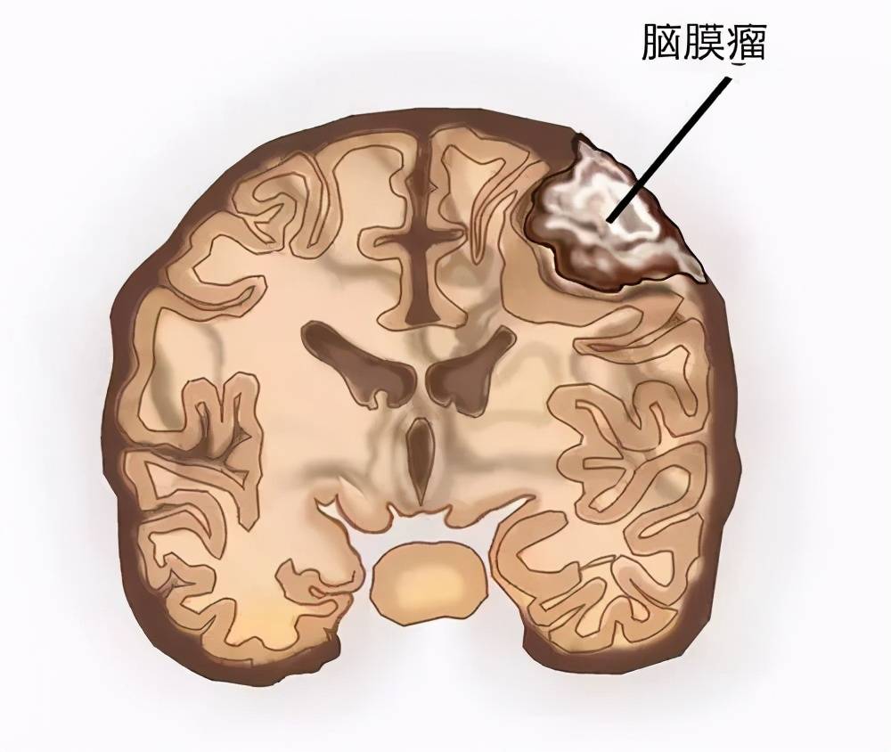 哪种头痛是脑瘤前兆 三种头痛最可怕