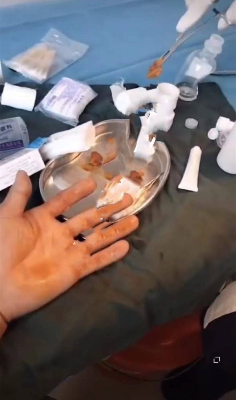 网红二驴直播间售卖手机爆炸 粉丝被炸伤手指缠满绷带(图3)