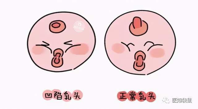 乳房正常没有头图片