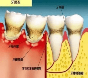 多见于严重蛀牙,补牙的患者牙根
