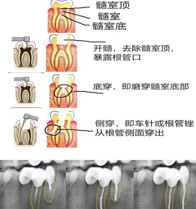 下颌七根管分布图图片