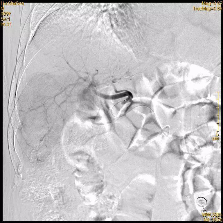 患者|高龄患者得肝癌就要放弃治疗？介入医生说“NO”！