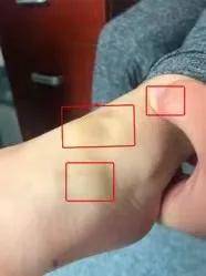 手术|认真听取主治医生的建议，是尽早康复的前提！